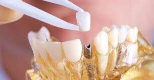 Как ставят зубные импланты в современной стоматологии?