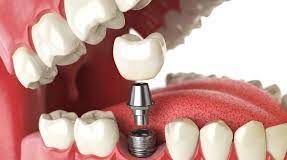 Методы и этапы имплантации зубов