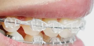 Разновидности брекетов и их особенности